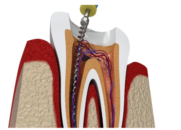 Endodoncia