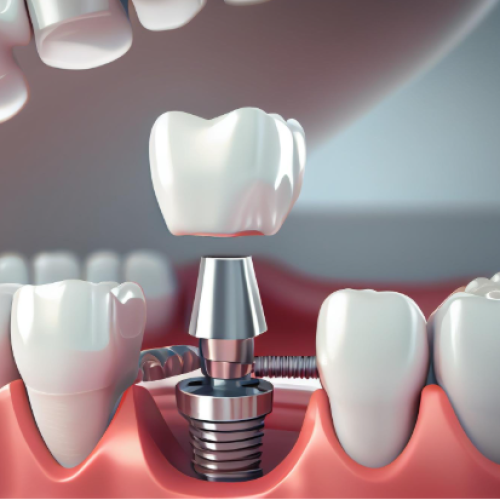 Implantes dentales