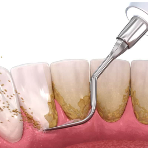 Periodoncia