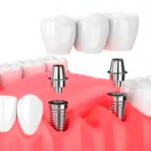 Prótesis dental: puente sobre implantes