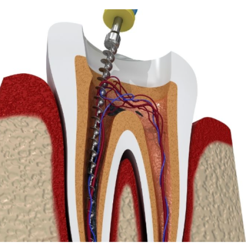 Endodoncia